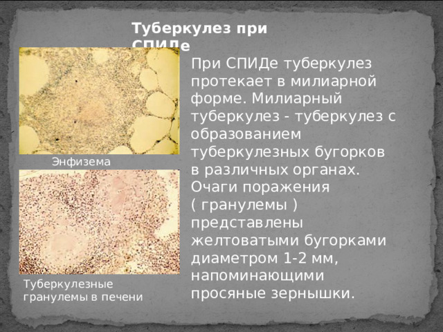 Туберкулез при СПИДе При СПИДе туберкулез протекает в милиарной форме. Милиарный туберкулез - туберкулез с образованием туберкулезных бугорков в различных органах.  Очаги поражения ( гранулемы ) представлены желтоватыми бугорками диаметром 1-2 мм, напоминающими просяные зернышки. Энфизема легких Туберкулезные гранулемы в печени 
