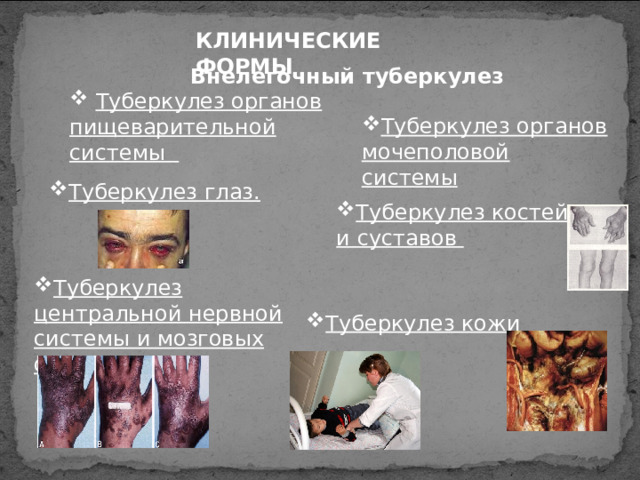 КЛИНИЧЕСКИЕ ФОРМЫ Внелегочный туберкулез  Туберкулез органов пищеварительной системы Туберкулез органов мочеполовой системы Туберкулез глаз. Туберкулез костей и суставов Туберкулез центральной нервной системы и мозговых оболочек Туберкулез кожи 