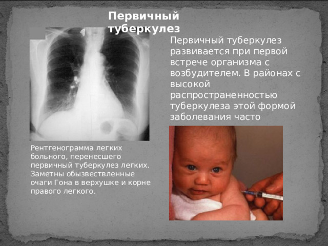 Первичный туберкулез Первичный туберкулез развивается при первой встрече организма с возбудителем. В районах с высокой распространенностью туберкулеза этой формой заболевания часто страдают дети. Рентгенограмма легких больного, перенесшего первичный туберкулез легких. Заметны обызвествленные очаги Гона в верхушке и корне правого легкого. 5 