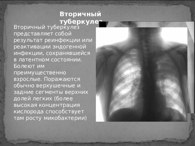 Вторичный туберкулез Вторичный туберкулез представляет собой результат реинфекции или реактивации эндогенной инфекции, сохранявшейся в латентном состоянии. Болеют им преимущественно взрослые. Поражаются обычно верхушечные и задние сегменты верхних долей легких (более высокая концентрация кислорода способствует там росту микобактерии)  Рентгенограмма органов грудной клетки в прямой проекции больного вторичным туберкулезом. 
