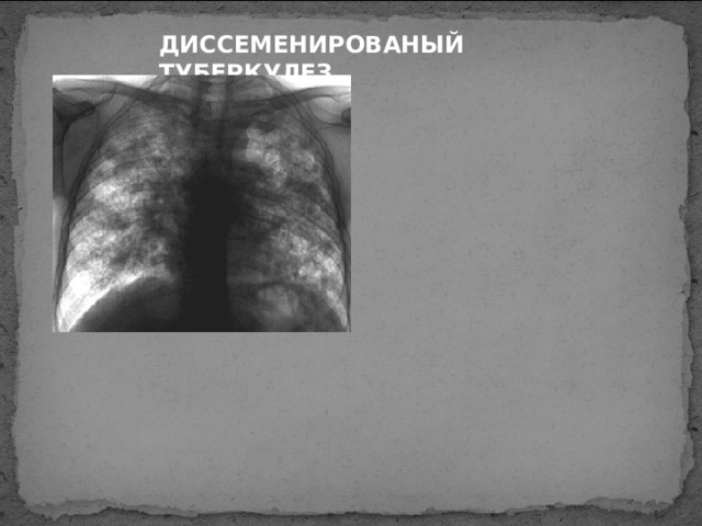 ДИССЕМЕНИРОВАН Ы Й ТУБЕРКУЛЕЗ 