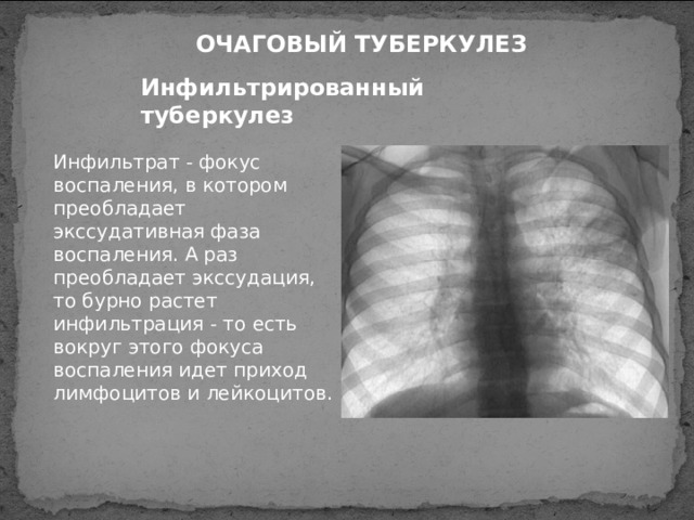 ОЧАГОВЫЙ ТУБЕРКУЛЕЗ Инфильтрированный туберкулез Инфильтрат - фокус воспаления, в котором преобладает экссудативная фаза воспаления. А раз преобладает экссудация, то бурно растет инфильтрация - то есть вокруг этого фокуса воспаления идет приход лимфоцитов и лейкоцитов.  