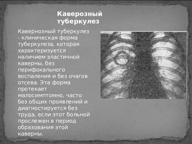 Каверозный туберкулез Кавернозный туберкулез - клиническая форма туберкулеза, которая характеризуется наличием эластичной каверны, без перифокального воспаления и без очагов отсева. Эта форма протекает малосимптомно, часто без общих проявлений и диагностируется без труда, если этот больной прослежен в период образования этой каверны. 