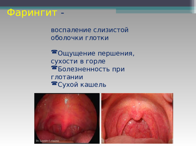 Фарингит - воспаление слизистой оболочки глотки Ощущение першения, сухости в горле Болезненность при глотании Сухой кашель 