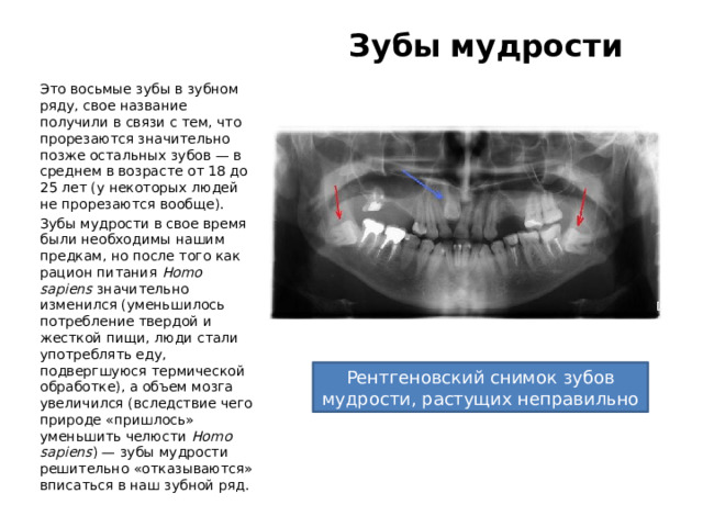 Зубы  мудрости Это восьмые зубы в зубном ряду, свое название получили в связи с тем, что прорезаются значительно позже остальных зубов — в среднем в возрасте от 18 до 25 лет (у некоторых людей не прорезаются вообще). Зубы мудрости в свое время были необходимы нашим предкам, но после того как рацион питания Homo  sapiens значительно изменился (уменьшилось потребление твердой и жесткой пищи, люди стали употреблять еду, подвергшуюся термической обработке), а объем мозга увеличился (вследствие чего природе «пришлось» уменьшить челюсти Homo  sapiens ) — зубы мудрости решительно «отказываются» вписаться в наш зубной ряд. Рентгеновский снимок зубов мудрости, растущих неправильно 