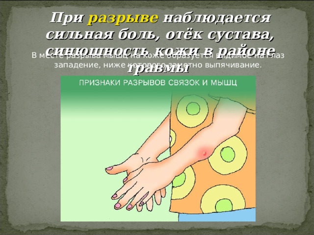 При разрыве наблюдается сильная боль, отёк сустава, синюшность кожи в районе травмы 