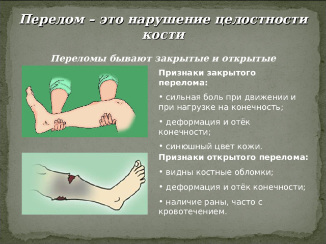 Перелом – это нарушение целостности кости  Переломы бывают закрытые и открытые Признаки закрытого перелома: Признаки открытого перелома: 