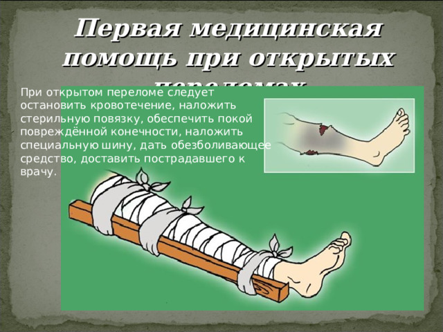 Первая медицинская помощь при открытых переломах 