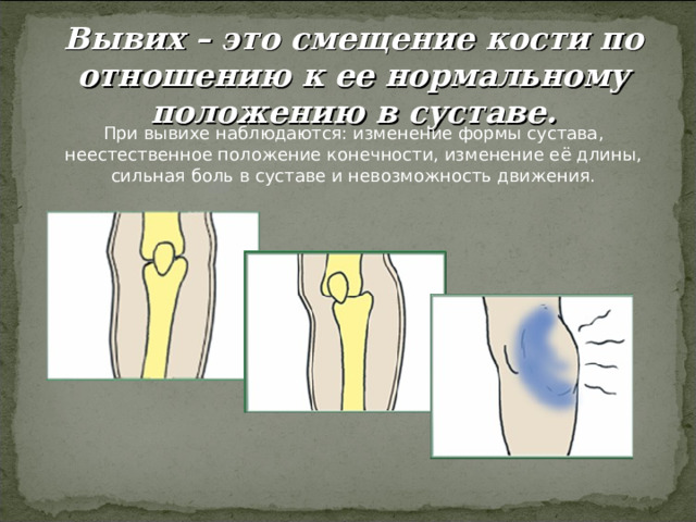 Вывих – это смещение кости по отношению к ее нормальному положению в суставе. 
