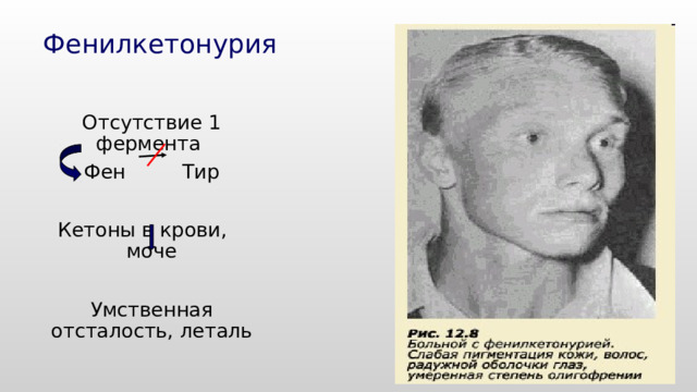 Фенилкетонурия  Отсутствие 1 фермента  Фен Тир  Кетоны в крови, моче  Умственная отсталость, леталь 