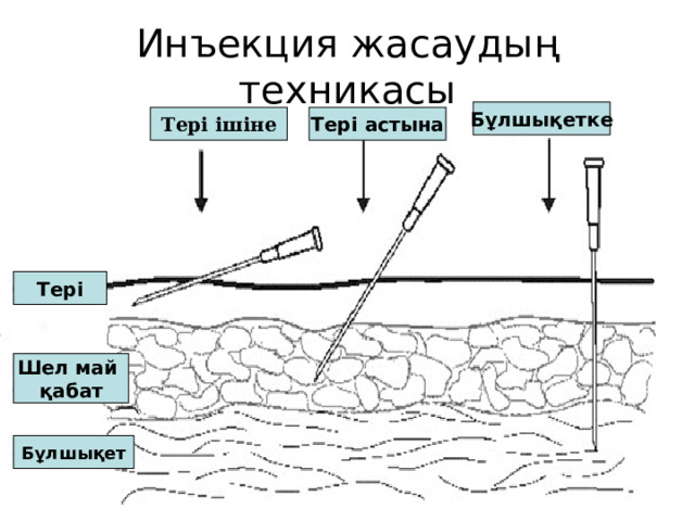 Инъекция жасаудың техникасы Бұлшықетке Тері ішіне Тері астына Тері Шел май қабат Бұлшықет  