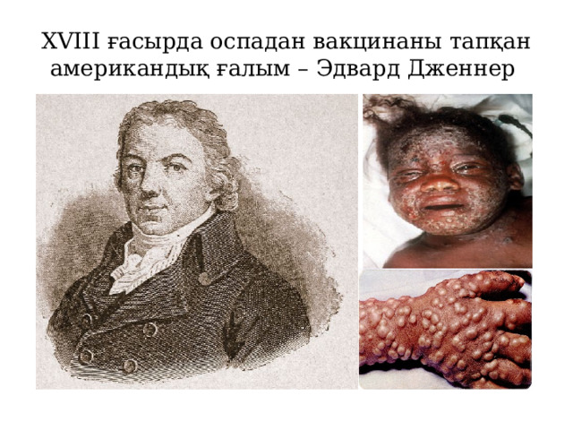 XVIII ғасырда оспадан вакцинаны тап қан американдық ғалым – Эдвард Дженнер 