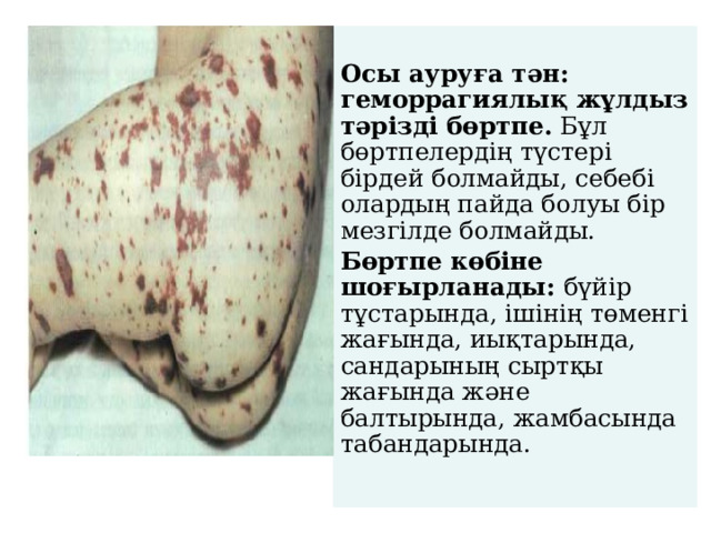  Осы ауруға тән: геморрагиялық жұлдыз тәрізді бөртпе. Бұл бөртпелердің түстері бірдей болмайды, себебі олардың пайда болуы бір мезгілде болмайды. Бөртпе көбіне шоғырланады: бүйір тұстарында, ішінің төменгі жағында, иықтарында, сандарының сыртқы жағында және балтырында, жамбасында табандарында.    