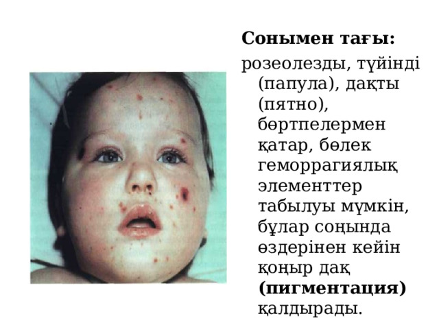  Сонымен тағы: розеолезды, түйінді (папула), дақты (пятно), бөртпелермен қатар, бөлек геморрагиялық элементтер табылуы мүмкін, бұлар соңында өздерінен кейін қоңыр дақ (пигментация) қалдырады. 