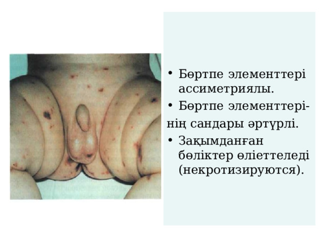    Бөртпе элементтері ассиметриялы. Бөртпе элементтері- нің сандары әртүрлі. Зақымданған бөліктер өліеттеледі (некротизируются). 