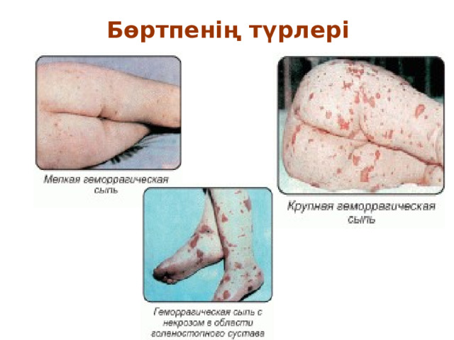 Бөр т пенің түрлері 
