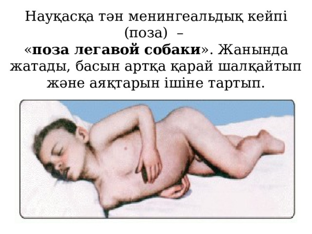 Науқасқа тән менингеальдық кейпі (поза) –  « поза легавой собаки ». Жанында жатады, басын артқа қарай шалқайтып және аяқтарын ішіне тартып. 