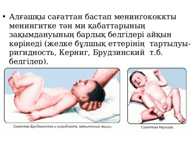  Алғашқы сағаттан бастап менингококкты менингитке тән ми қабаттарының зақымдануының барлық белгілері айқын көрінеді (желке бұлшық еттерінің тартылуы- ригидность, Керниг, Брудзинский т.б. белгілер). 