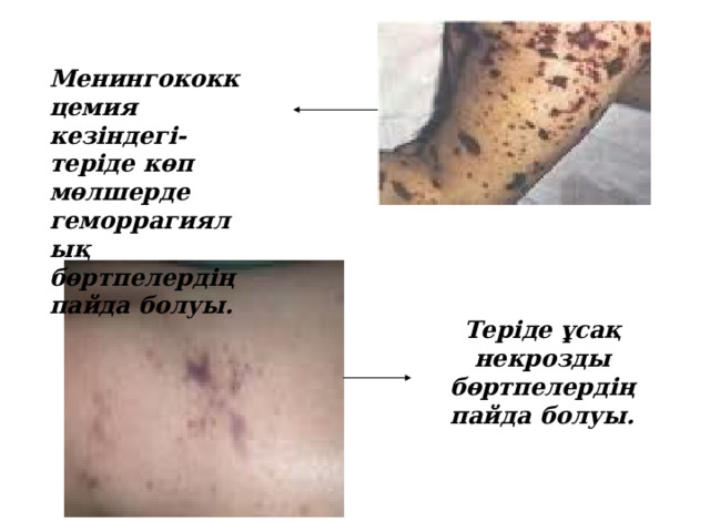 Менингококкцемия кезіндегі-теріде көп мөлшерде геморрагиялық бөртпелердің пайда болуы. Теріде ұсақ некрозды бөртпелердің пайда болуы. 