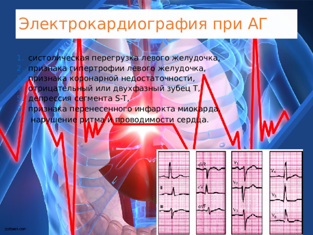 Электрокардиография при АГ систолическая перегрузка левого желудочка, признака гипертрофии левого желудочка, признака коронарной недостаточности, отрицательный или двухфазный зубец T, депрессия сегмента S-T, признака перенесенного инфаркта миокарда,  нарушение ритма и проводимости сердца . 