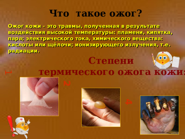 1 2 4 Что такое ожог?  Ожог кожи - это травмы, полученная в результате воздействия высокой температуры: пламени, кипятка, пара; электрического тока, химического вещества: кислоты или щёлочи; ионизирующего излучения, т.е. радиации. Степени термического ожога кожи: 