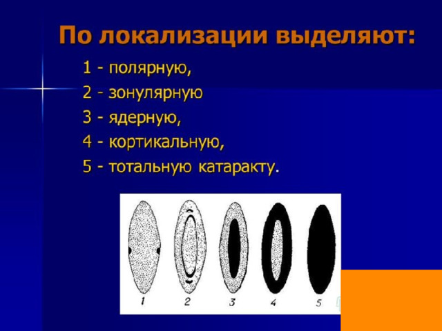 Катаракта Незрелая 