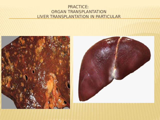 Practice:  Organ transplantation  Liver transplantation in particular 