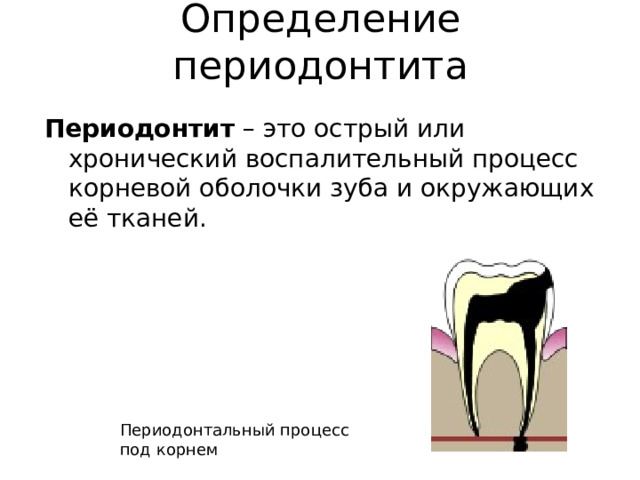 Определение периодонтита Периодонтит  – это острый или хронический воспалительный процесс корневой оболочки зуба и окружающих её тканей.  Периодонтальный процесс под корнем 