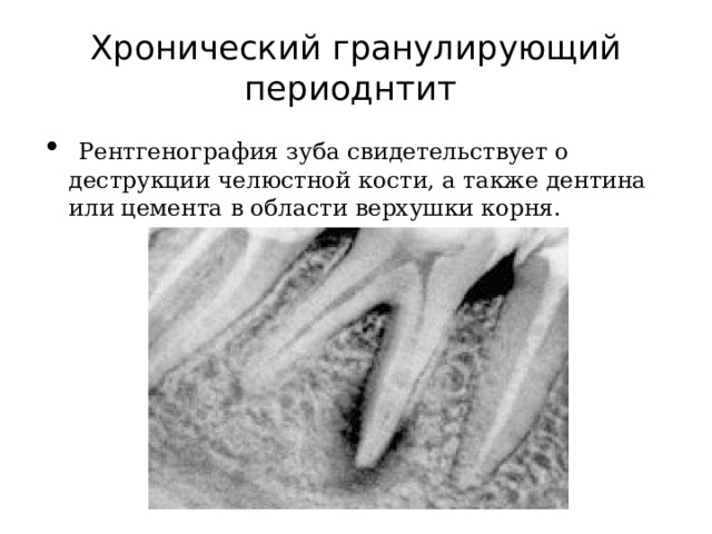 Хронический гранулирующий периоднтит   Рентгенография зуба свидетельствует о деструкции челюстной кости, а также дентина или цемента в области верхушки корня.   