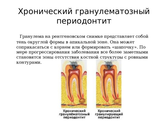 Хронический гранулематозный периодонтит   Гранулема на рентгеновском снимке представляет собой тень округлой формы в апикальной зоне. Она может соприкасаться с корнем или формировать «шапочку». По мере прогрессирования заболевания все более заметными становятся зоны отсутствия костной структуры с ровными контурами.    
