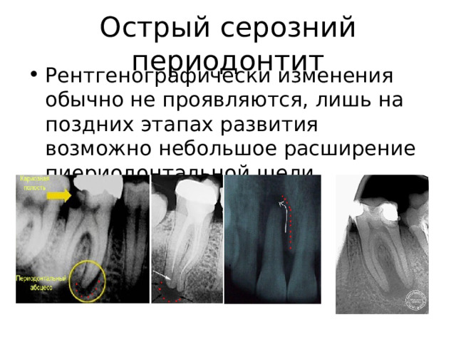Острый серозний периодонтит Рентгенографически изменения обычно не проявляются, лишь на поздних этапах развития возможно небольшое расширение пиериодонтальной щели. 