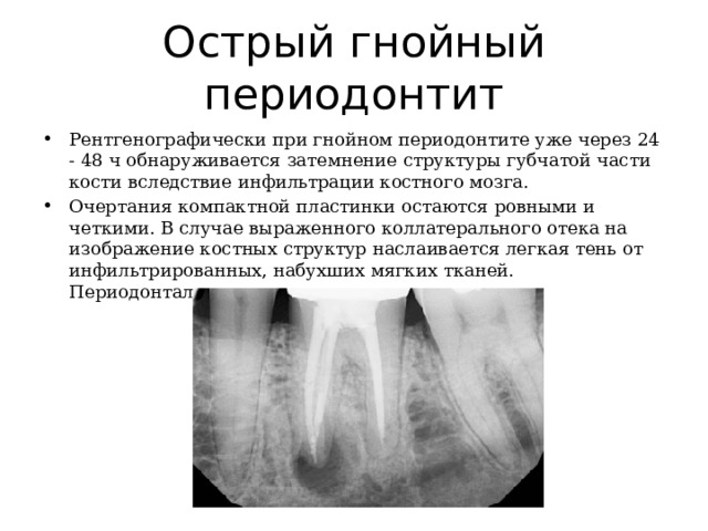 Острый гнойный периодонтит Рентгенографически при гнойном периодонтите уже через 24 - 48 ч обнаруживается затемнение структуры губчатой ​​части кости вследствие инфильтрации костного мозга. Очертания компактной пластинки остаются ровными и четкими. В случае выраженного коллатерального отека на изображение костных структур наслаивается легкая тень от инфильтрированных, набухших мягких тканей. Периодонтальная щель расширена.  