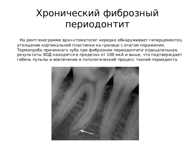 Хронический фиброзный периодонтит  На рентгенограмме врач-стоматолог нередко обнаруживает гиперцементоз, утолщение кортикальной пластинки на границе с очагом поражения. Термопроба причинного зуба при фиброзном периодонтите отрицательная, результаты ЭОД находятся в пределах от 100 мкА и выше, что подтверждает гибель пульпы и вовлечение в патологический процесс тканей периодонта.    