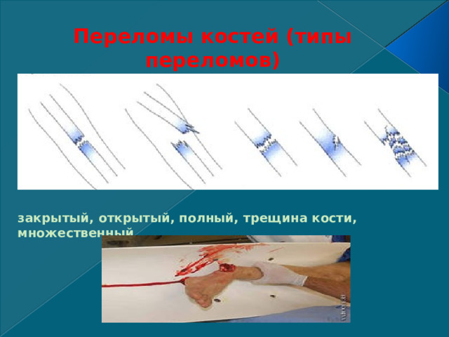 Переломы костей (типы переломов) закрытый, открытый, полный, трещина кости, множественный     