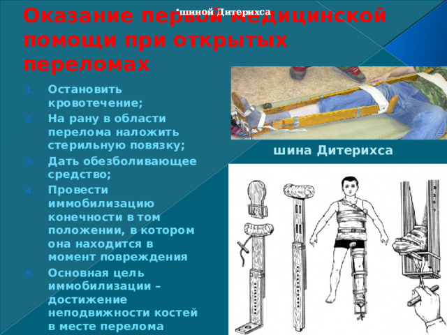 Оказание первой медицинской помощи при открытых переломах шиной Дитерихса шиной Дитерихса Остановить кровотечение; На рану в области перелома наложить стерильную повязку; Дать обезболивающее средство; Провести иммобилизацию конечности в том положении, в котором она находится в момент повреждения Основная цель иммобилизации – достижение неподвижности костей в месте перелома  шина Дитерихса 