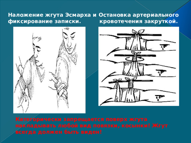 Остановка артериального кровотечения закруткой. Наложение жгута Эсмарха и фиксирование записки. Категорически запрещается поверх жгута накладывать любой вид повязки, косынки! Жгут всегда должен быть виден! 