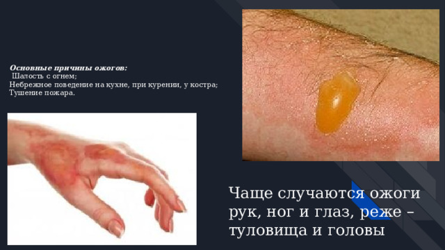 Основные причины ожогов:  Шалость с огнем;  Небрежное поведение на кухне, при курении, у костра;  Тушение пожара.     Чаще случаются ожоги рук, ног и глаз, реже – туловища и головы 