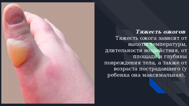 Тяжесть ожогов  Тяжесть ожога зависит от высоты температуры, длительности воздействия, от площади и глубины повреждения тела, а также от возраста пострадавшего (у ребенка она максимальная). 