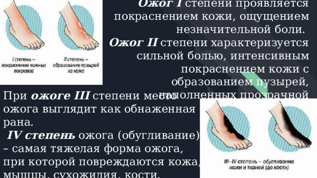 Степени ожогов   Ожог I степени проявляется покраснением кожи, ощущением незначительной боли.  Ожог II  степени характеризуется сильной болью, интенсивным покраснением кожи с образованием пузырей, наполненных прозрачной жидкостью.   При ожоге III  степени место ожога выглядит как обнаженная рана.  IV степень  ожога (обугливание) – самая тяжелая форма ожога, при которой повреждаются кожа, мышцы, сухожилия, кости. 