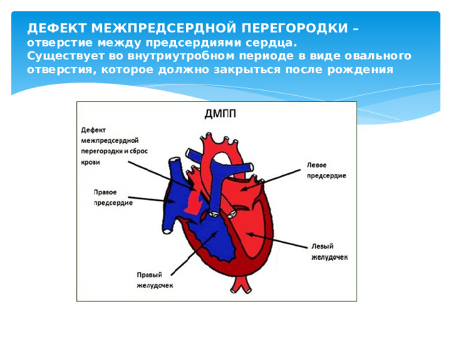 ДЕФЕКТ МЕЖПРЕДСЕРДНОЙ ПЕРЕГОРОДКИ – отверстие между предсердиями сердца.  Существует во внутриутробном периоде в виде овального отверстия, которое должно закрыться после рождения 
