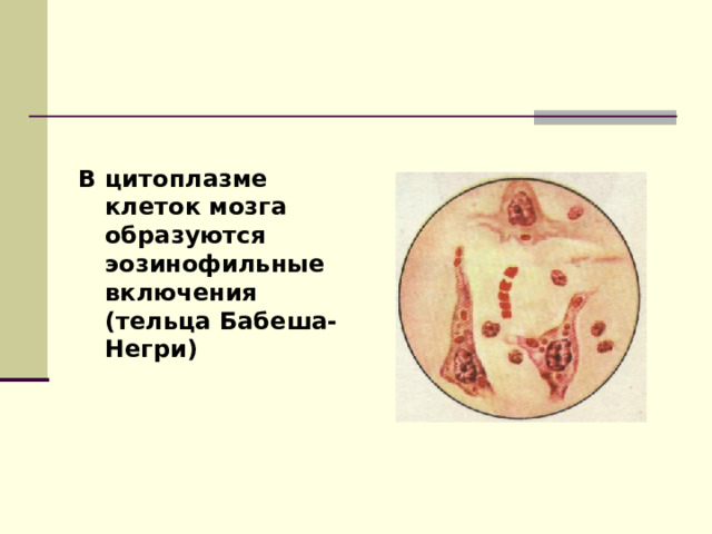  В цитоплазме клеток мозга образуются эозинофильные включения (тельца Бабеша-Негри) 