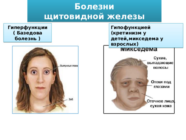 Болезни щитовидной железы Гиперфункции Гипофункцией (кретинизм у детей,микседема у взрослых) ( Базедова болезнь ) 