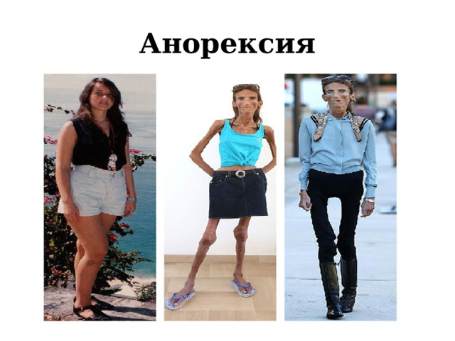 Анорексия 