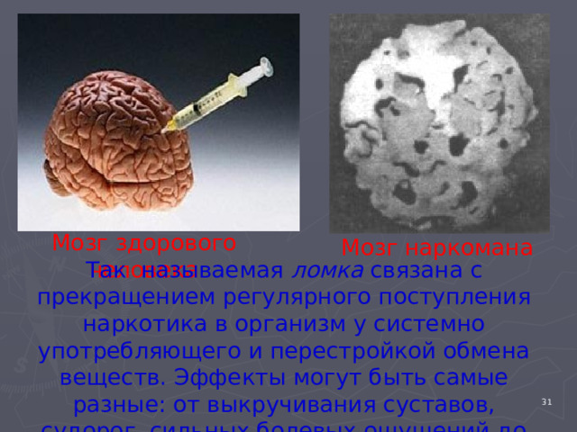 Мозг здорового человека Мозг наркомана Так называемая ломка связана с прекращением регулярного поступления наркотика в организм у системно употребляющего и перестройкой обмена веществ. Эффекты могут быть самые разные: от выкручивания суставов, судорог, сильных болевых ощущений до легкого дискомфорта или чувства жара. 4 