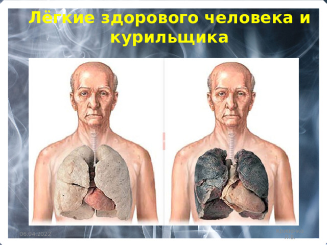 Лёгкие здорового человека и курильщика 06.04.2022 Кривенко Л.В. 