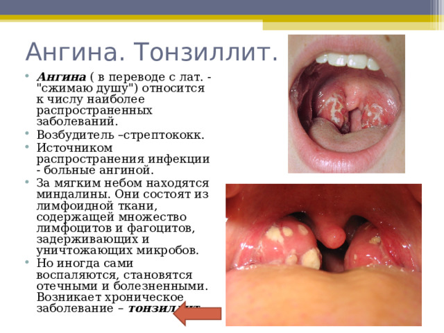 Ангина. Тонзиллит. Ангина ( в переводе с лат. - 