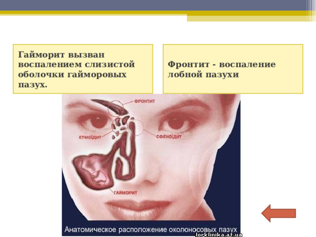 Гайморит вызван воспалением слизистой оболочки гайморовых пазух. Фронтит - воспаление лобной пазухи 