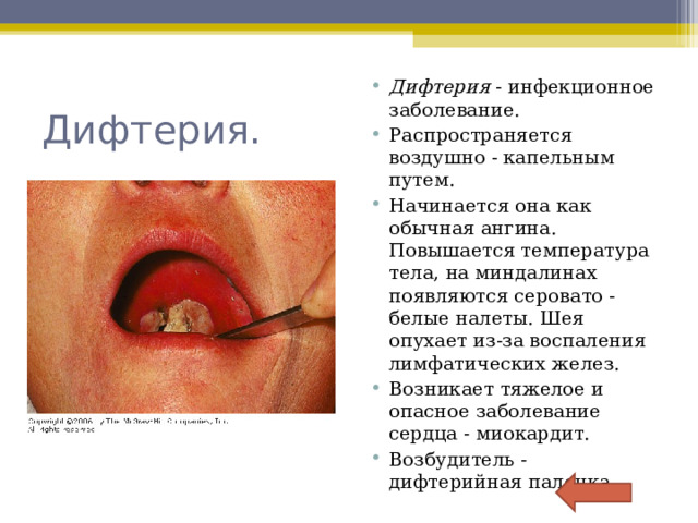 Дифтерия - инфекционное заболевание. Распространяется воздушно - капельным путем. Начинается она как обычная ангина. Повышается температура тела, на миндалинах появляются серовато - белые налеты. Шея опухает из-за воспаления лимфатических желез. Возникает тяжелое и опасное заболевание сердца - миокардит. Возбудитель - дифтерийная палочка.  Дифтерия. 