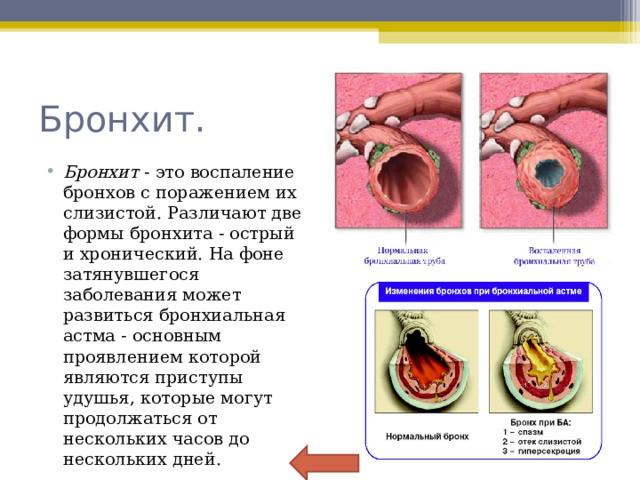 Бронхит. Бронхит - это воспаление бронхов с поражением их слизистой. Различают две формы бронхита - острый и хронический. На фоне затянувшегося заболевания может развиться бронхиальная астма - основным проявлением которой являются приступы удушья, которые могут продолжаться от нескольких часов до нескольких дней.  