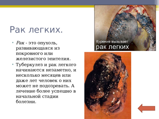 Рак легких. Рак - это опухоль, развивающаяся из покровного или железистого эпителия. Туберкулез и рак легкого начинаются незаметно, и несколько месяцев или даже лет человек о них может не подозревать. А лечение более успешно в начальной стадии болезни.  